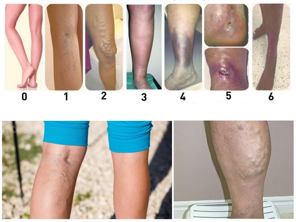 Etapas de desarrollo de las venas varicosas en las piernas.