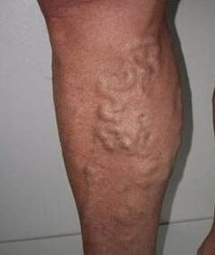 Venas varicosas atropelladas
