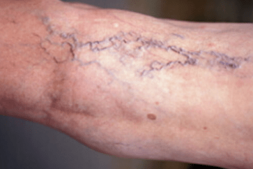 Varices