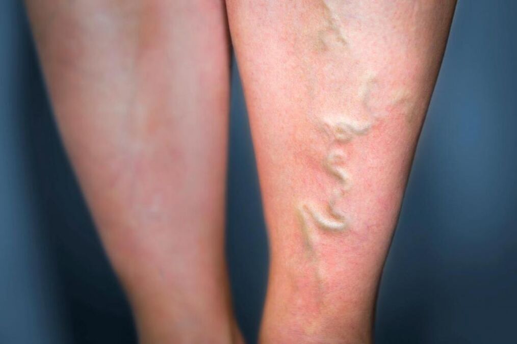 varices