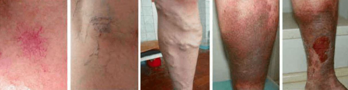 Etapas de las venas varicosas en las piernas