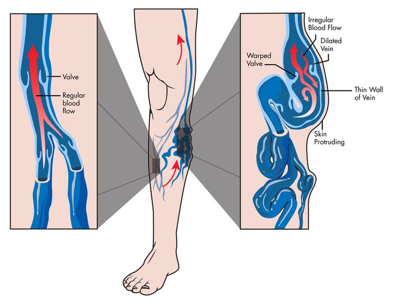 Varices