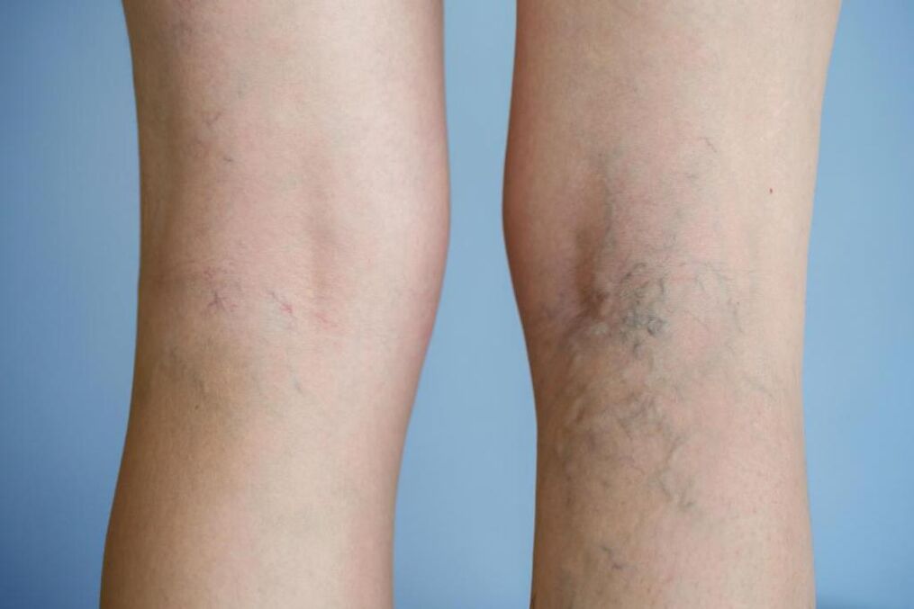 Varices