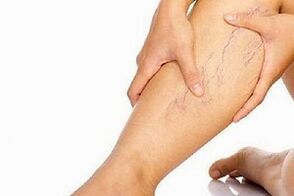 Las razones para el desarrollo de las venas varicosas en las piernas