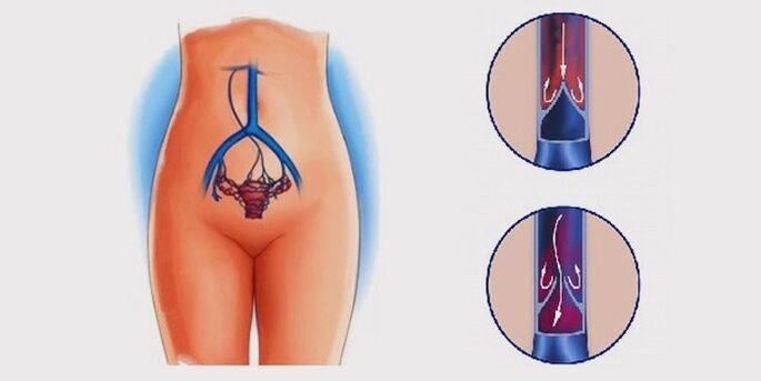 ¿Por qué aparecen las venas varicosas de la pelvis