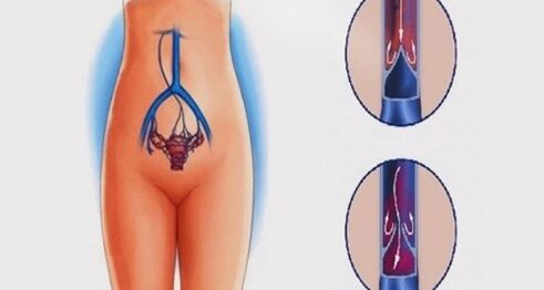 Anatomía de los órganos genitales femeninos y venas afectadas por varices en la pelvis.